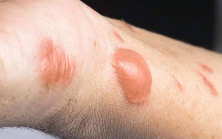 روش های مقابله و درمان انواع سوختگی IMG 4516 - روش های مقابله و درمان انواع سوختگی