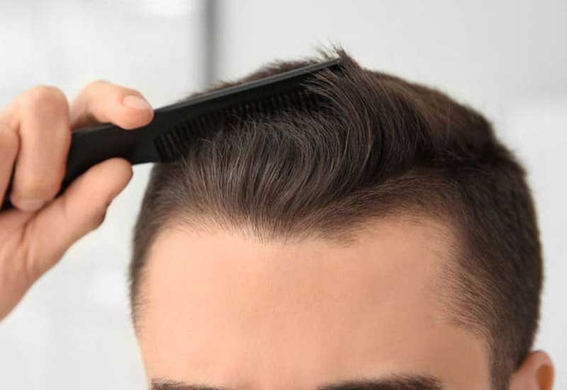 عواقب کاشت مو در مراکز غیر معتبر 239cdcd7 0818 4b23 ba66 d1836e834227 - عواقب کاشت مو در مراکز غیر معتبر